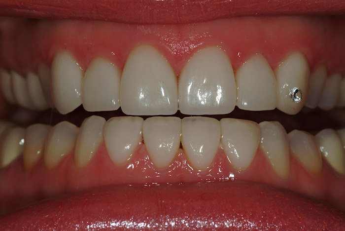 Look At Our Patients Smile Gallery-Pinnacle Dental