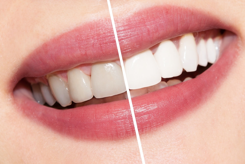 Teeth Whitening in Downtown Calgary