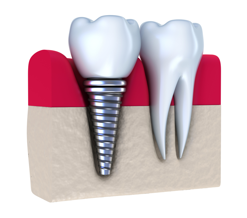 Dental Implants in Calgary