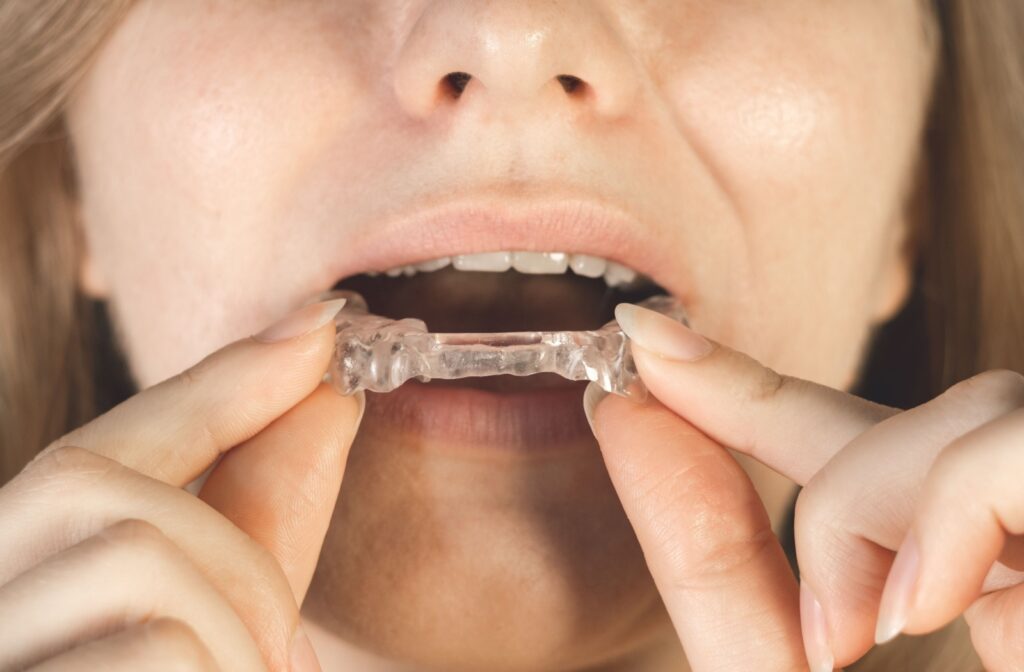 A close-up image of someone putting a mouth splint in before bed.