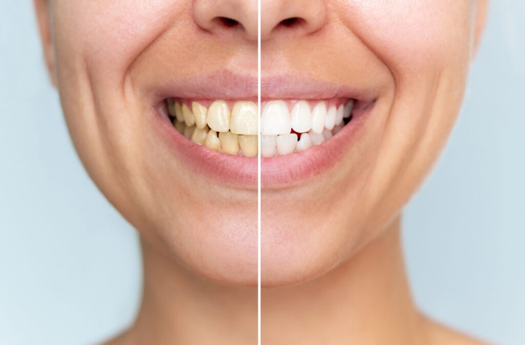 A side by side comparison of yellow teeth and white teeth