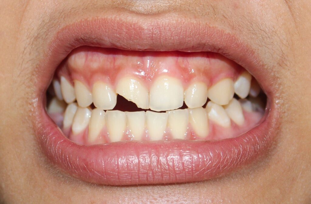 A close up of a person mouth where their front tooth is chipped